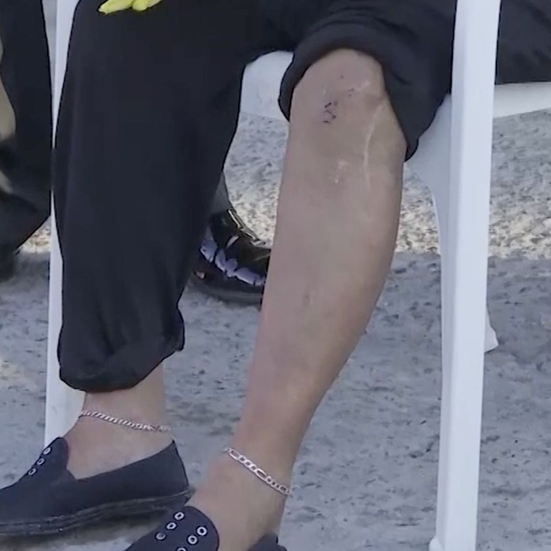 Adulta Mayor Resulta Lesionada tras Resbalar en Charco y Caer de Vehículo Eléctrico en Torreón